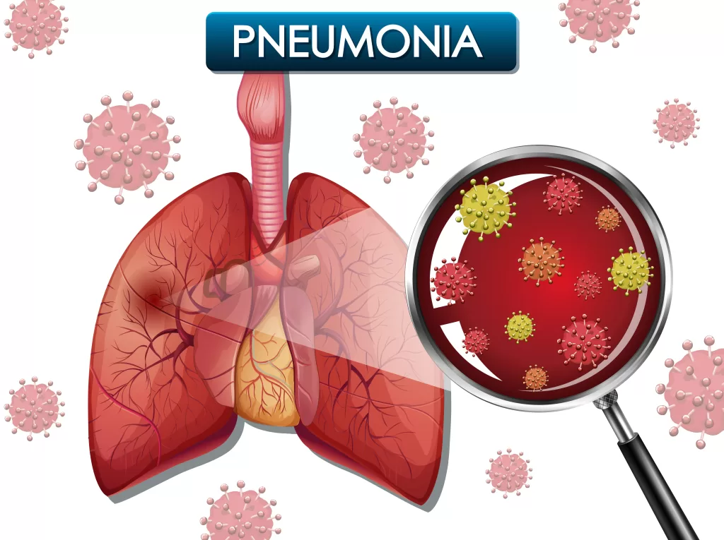 Chest Pain in Pneumonia