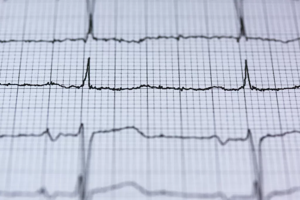 Angina on an Electrocardiogram t-wave changes