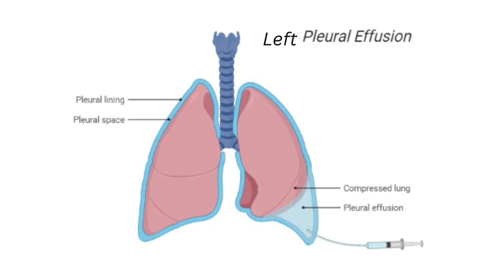 Left-Sided Pleural Effusion Causes