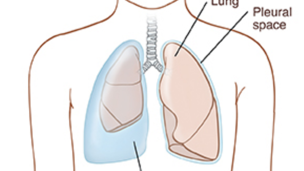 Right Sided Pleural Effusion Causes