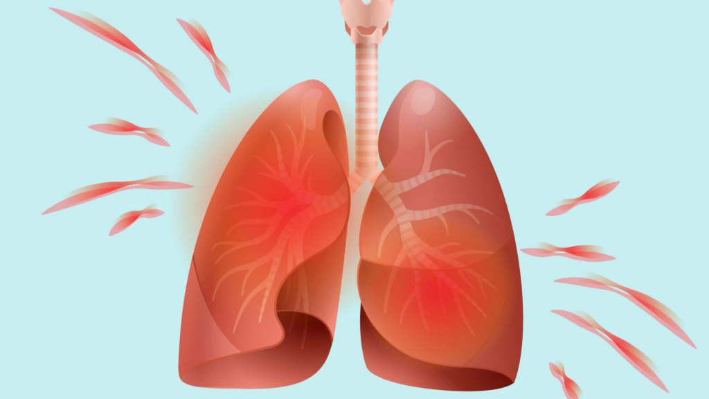 What are the 8 Best Medicines for Lung Pain?