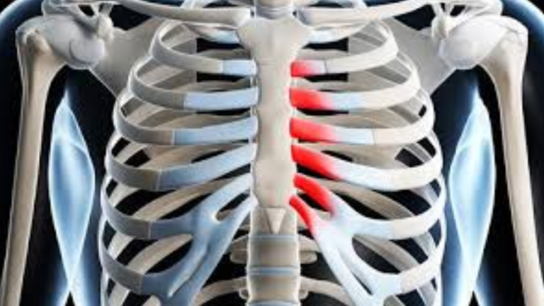 Major Costochondritis Symptoms