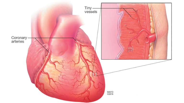 Microvascular Angina: Symptoms, Diagnosis, and Treatment