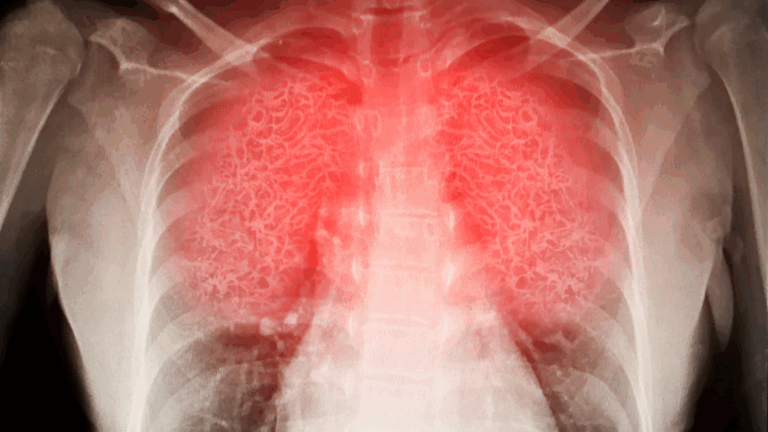 lung inflammation