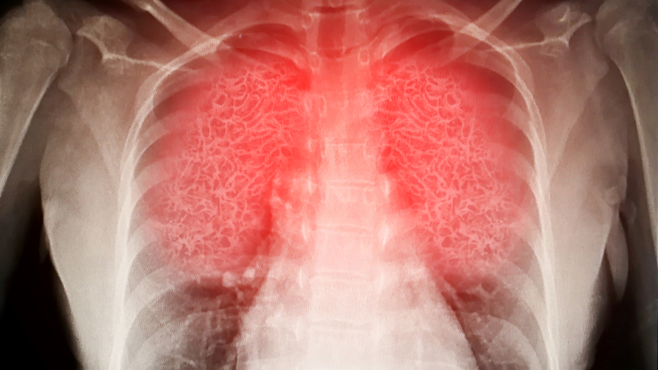lung inflammation