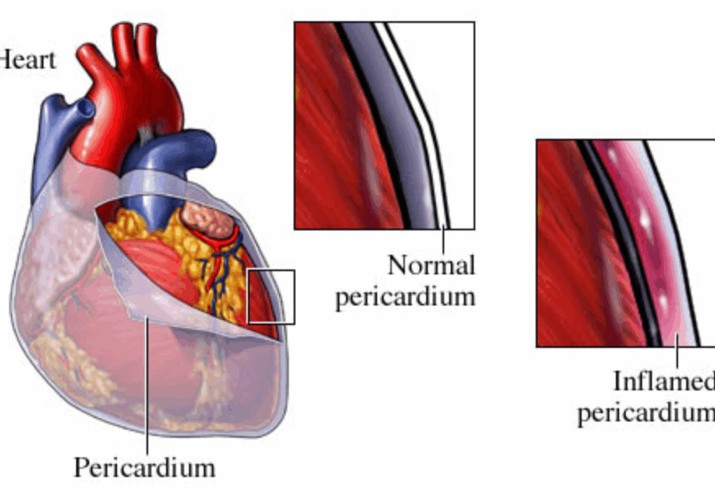 causes of pericarditis chest pain