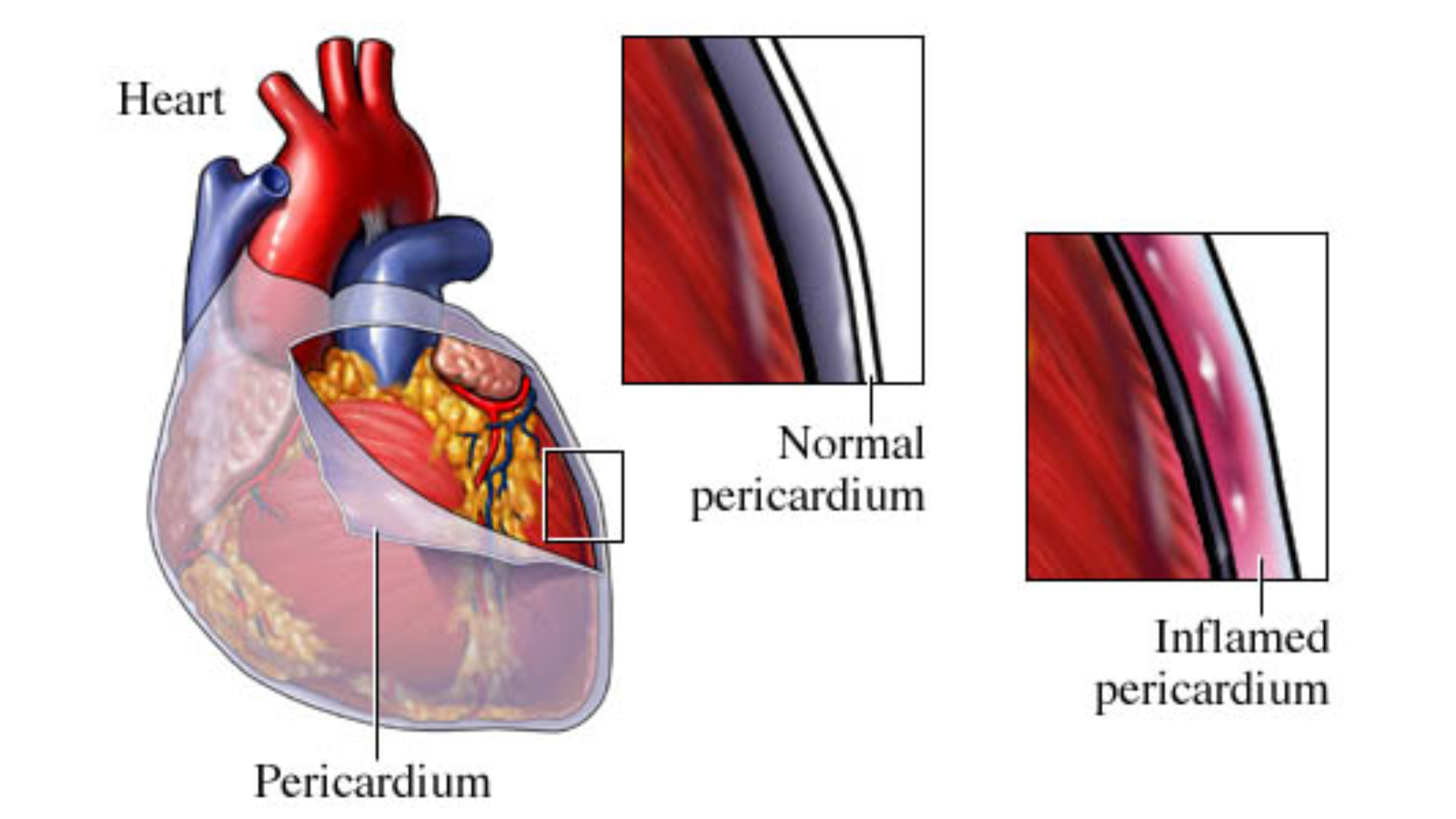 causes of pericarditis chest pain